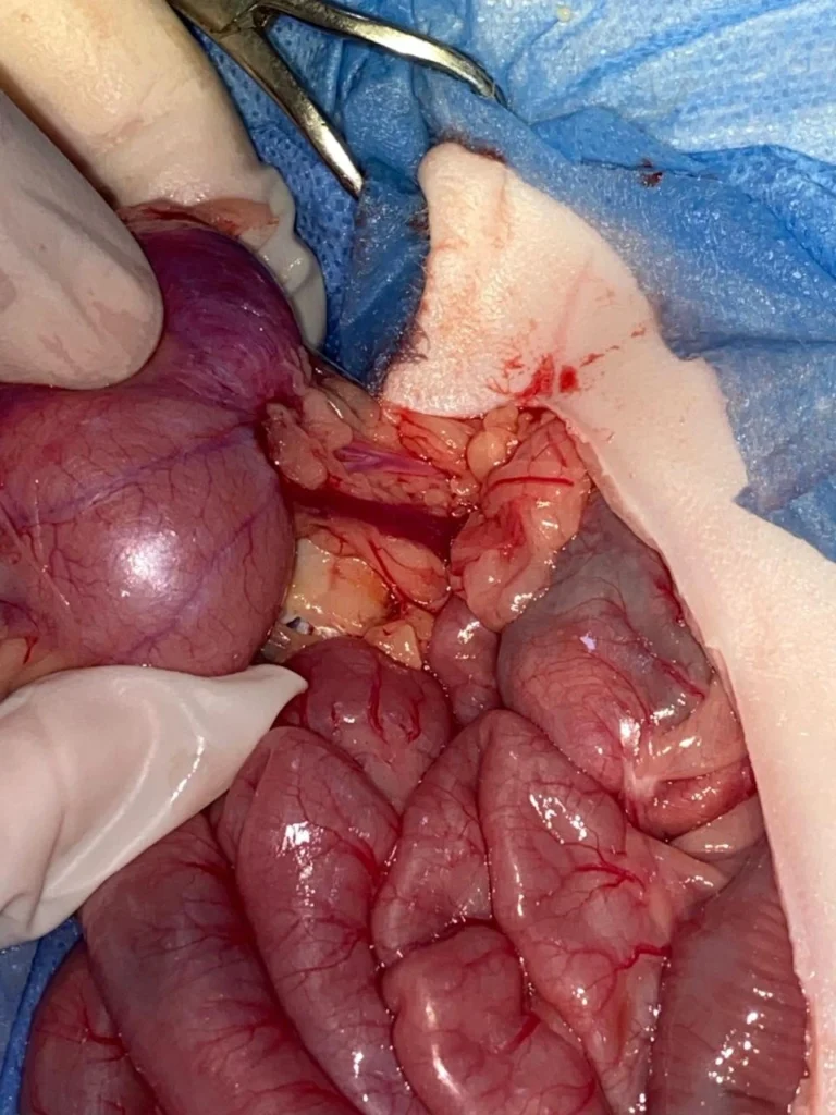 High Rise Syndrome-Spinal Fracture-Ruptured Ureter 5 IMG 20250416 WA0041